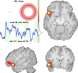 \includegraphics[width=0.48\textwidth]{images/results_broca.eps}