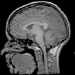 \includegraphics[height=5.4cm]{images/mri_sagittal.eps}