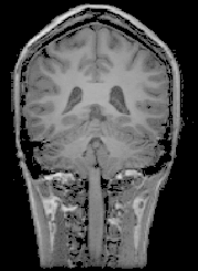 \includegraphics[height=5.4cm]{images/mri_frontal.eps}